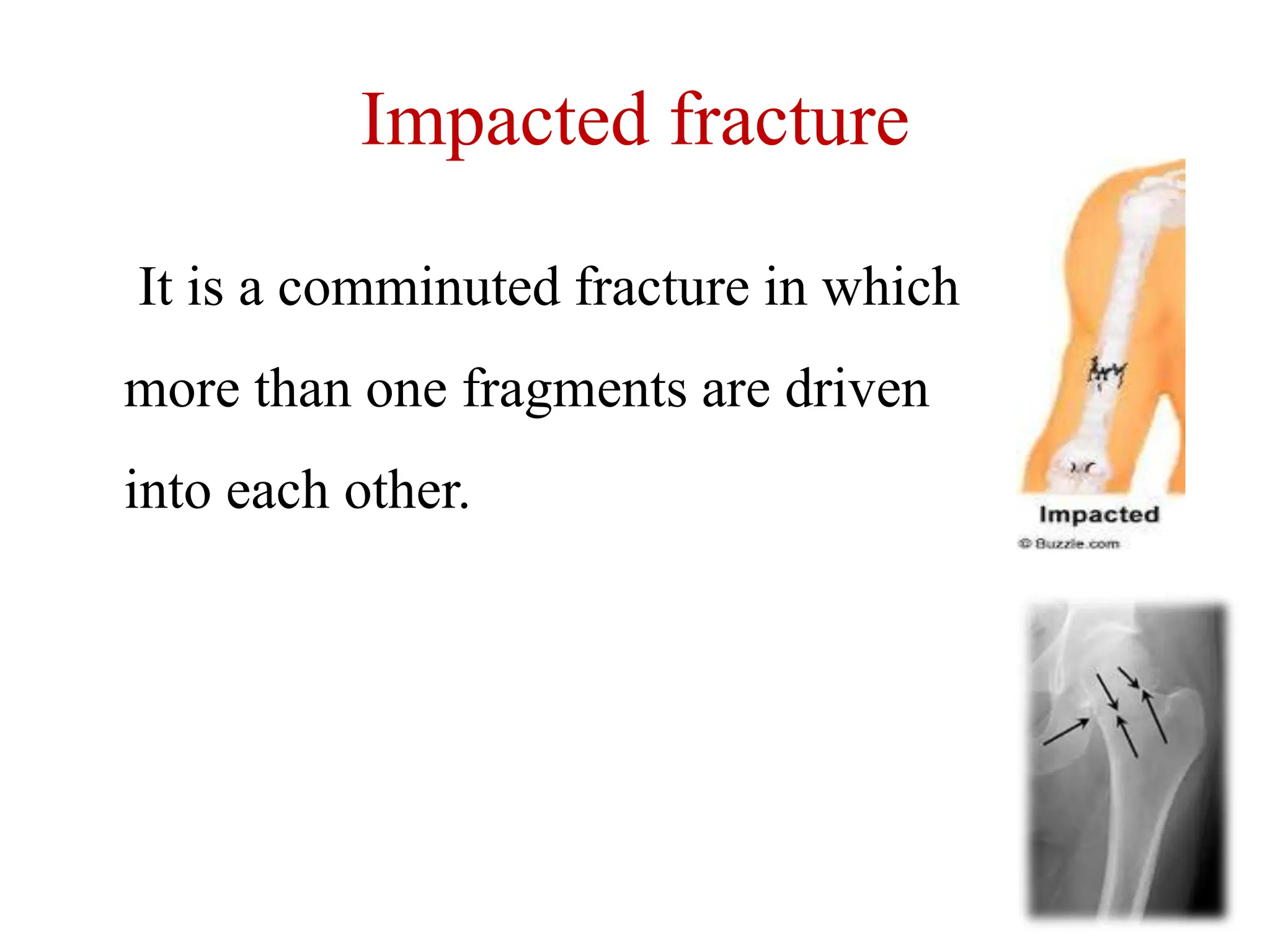 Impacted fracture
It is a comminuted fracture in which
more than one fragments are driven
into each other.
 