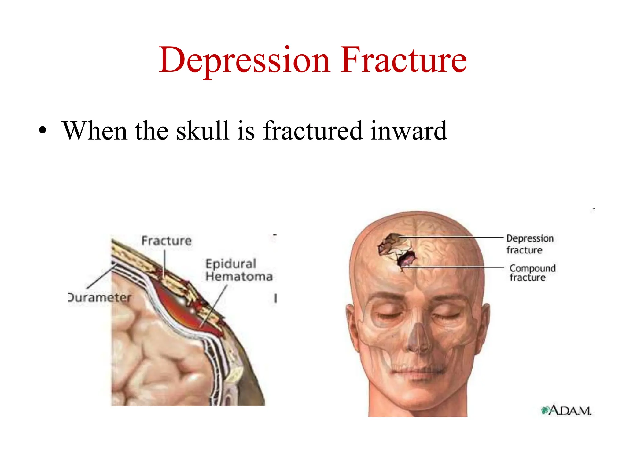 Depression Fracture
• When the skull is fractured inward
 