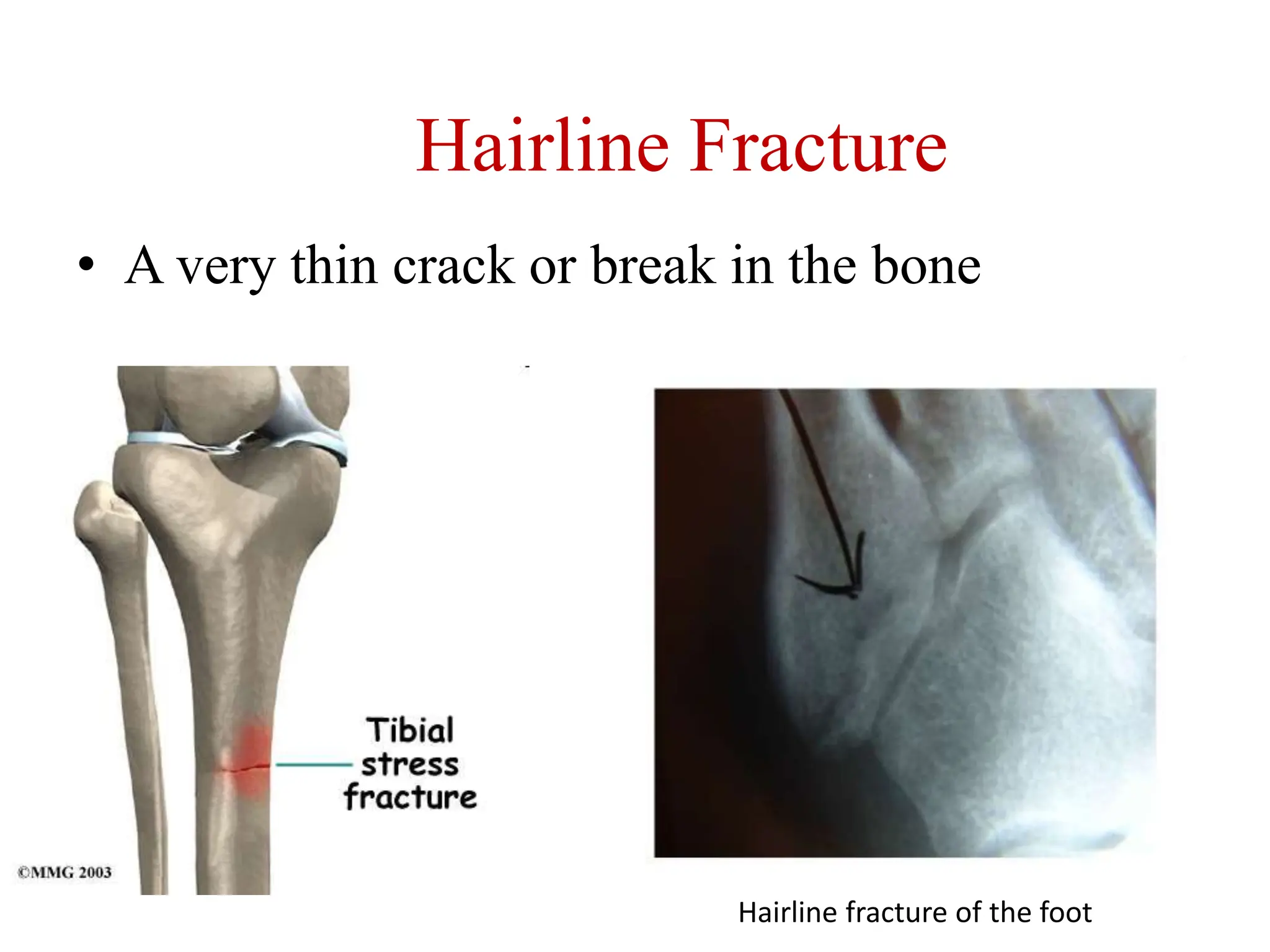 Hairline Fracture
• A very thin crack or break in the bone
Hairline fracture of the foot
 