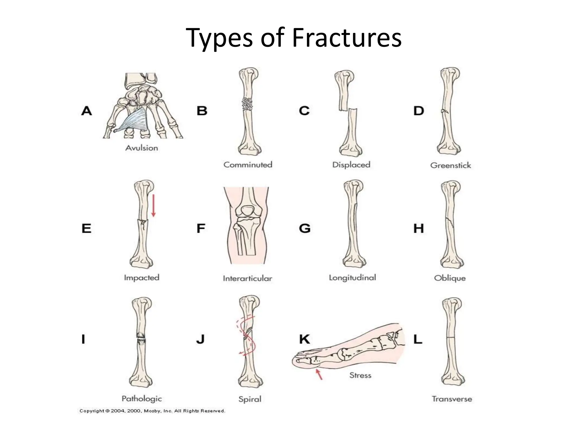 Types of Fractures
 