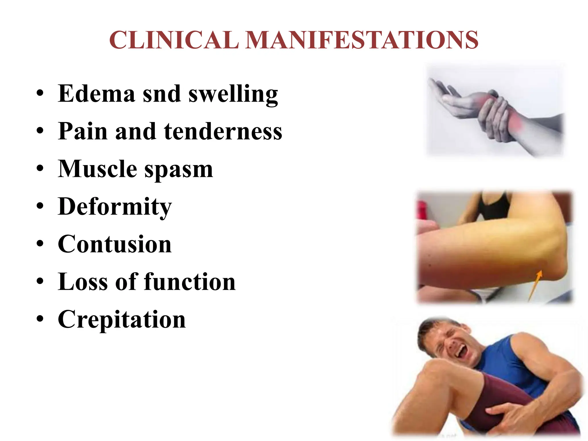 CLINICAL MANIFESTATIONS
• Edema snd swelling
• Pain and tenderness
• Muscle spasm
• Deformity
• Contusion
• Loss of function
• Crepitation
 