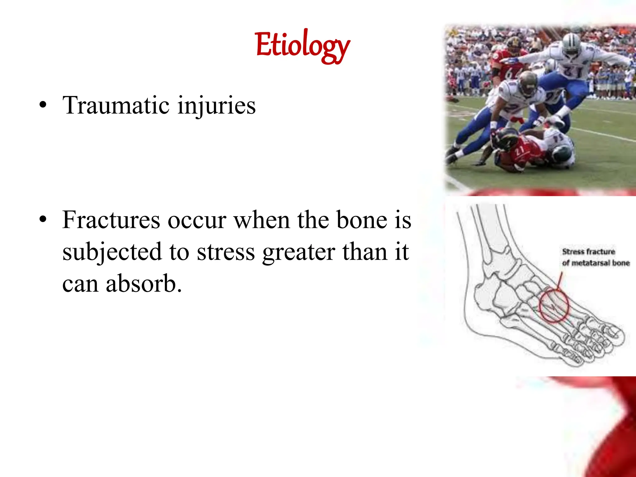 Etiology
• Traumatic injuries
• Fractures occur when the bone is
subjected to stress greater than it
can absorb.
 