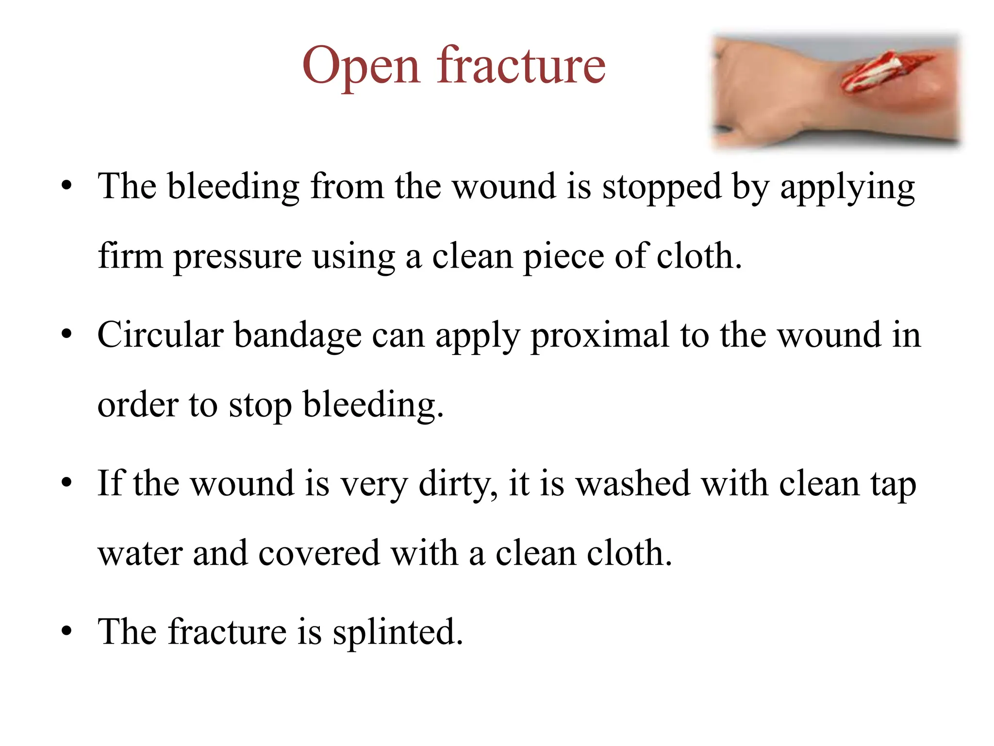 Open fracture
• The bleeding from the wound is stopped by applying
firm pressure using a clean piece of cloth.
• Circular bandage can apply proximal to the wound in
order to stop bleeding.
• If the wound is very dirty, it is washed with clean tap
water and covered with a clean cloth.
• The fracture is splinted.
 