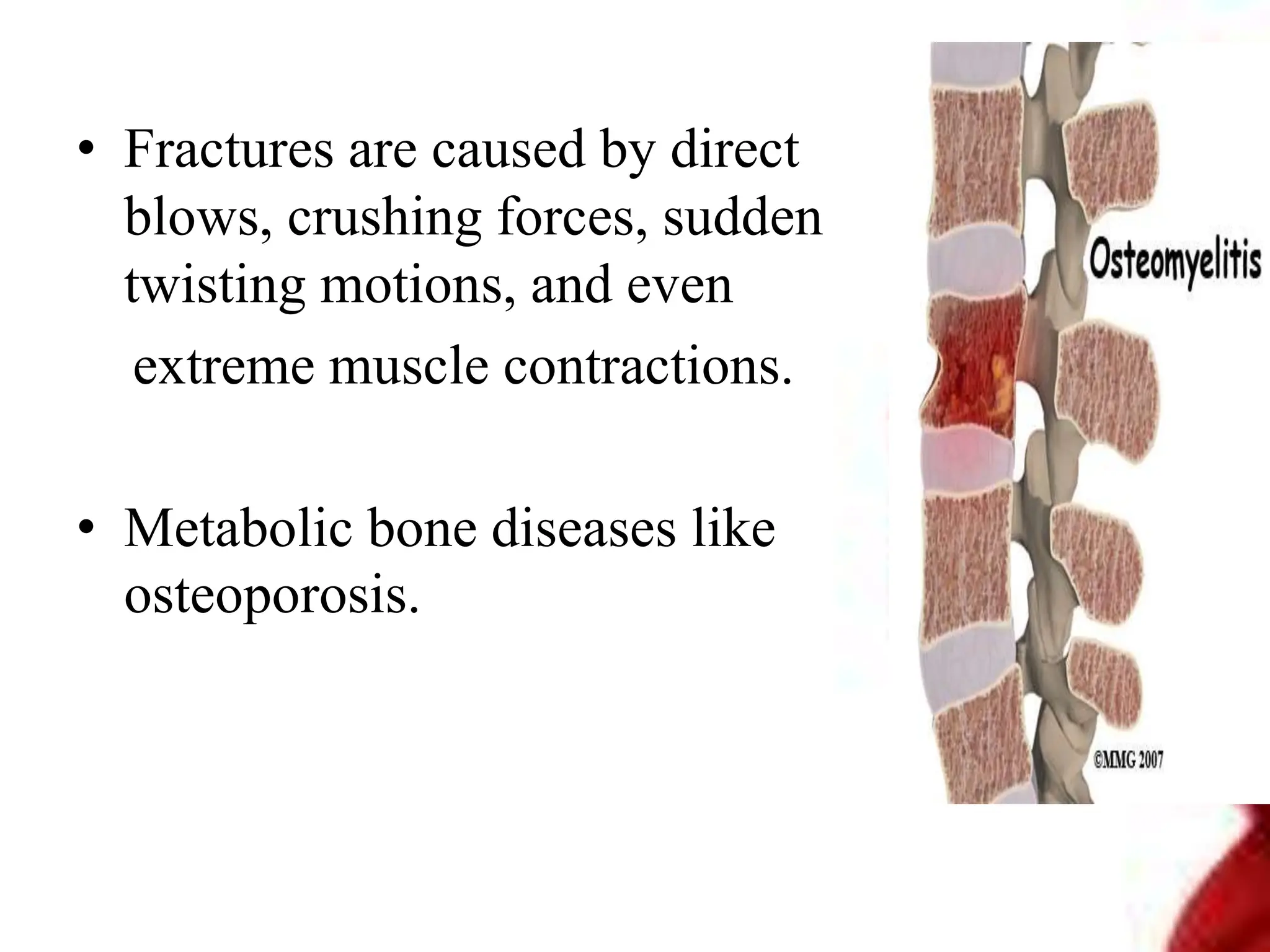 • Fractures are caused by direct
blows, crushing forces, sudden
twisting motions, and even
extreme muscle contractions.
• Metabolic bone diseases like
osteoporosis.
 