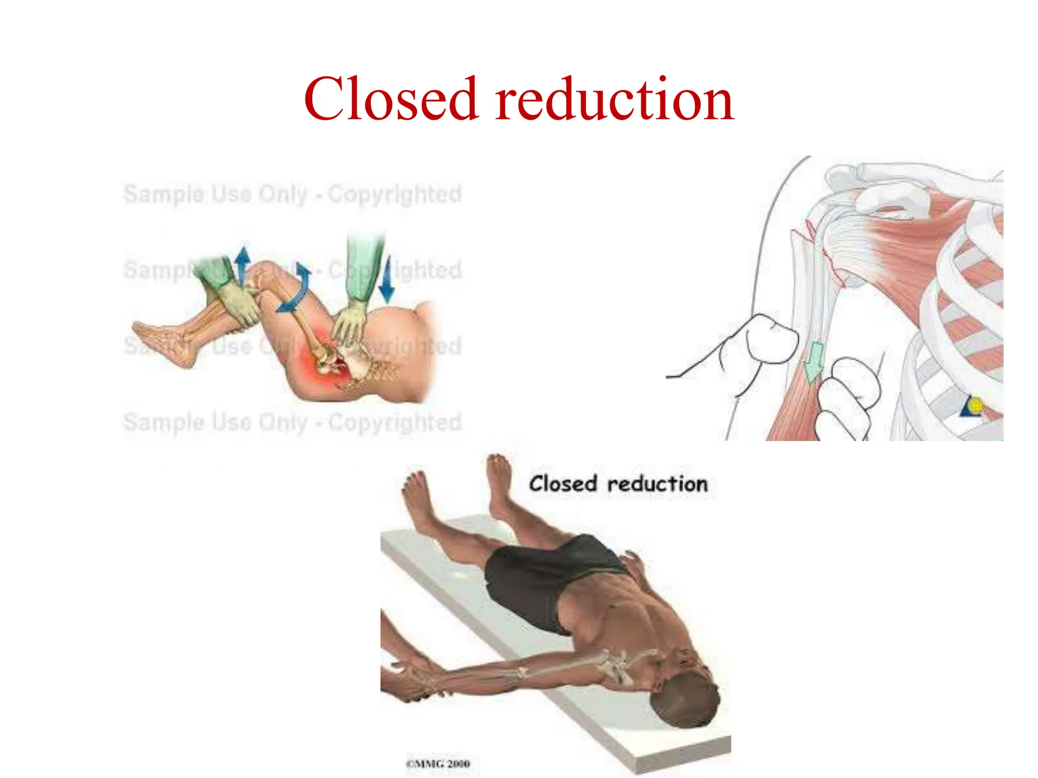 Closed reduction
 
