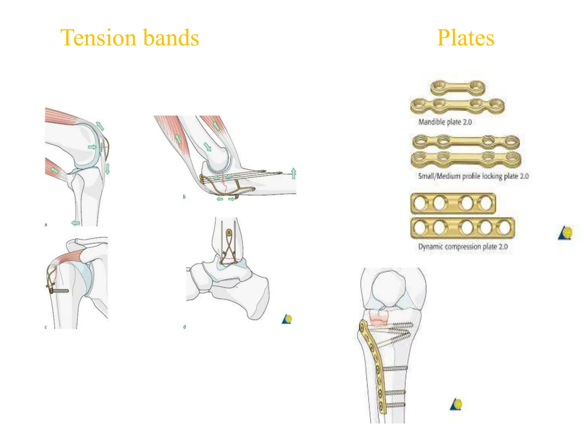 Tension bands Plates
 