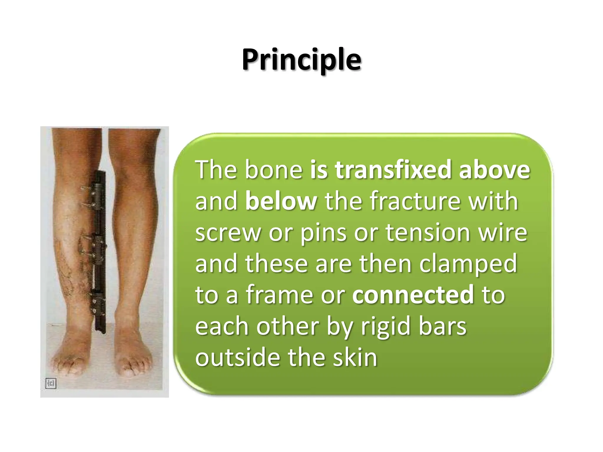 Principle
The bone is transfixed above
and below the fracture with
screw or pins or tension wire
and these are then clamped
to a frame or connected to
each other by rigid bars
outside the skin
 