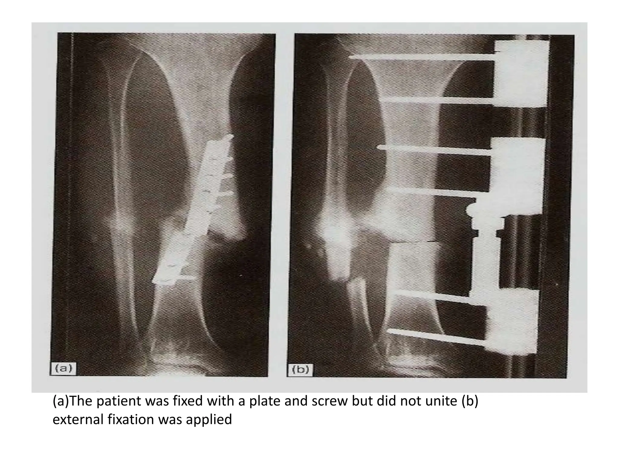 (a)The patient was fixed with a plate and screw but did not unite (b)
external fixation was applied
 