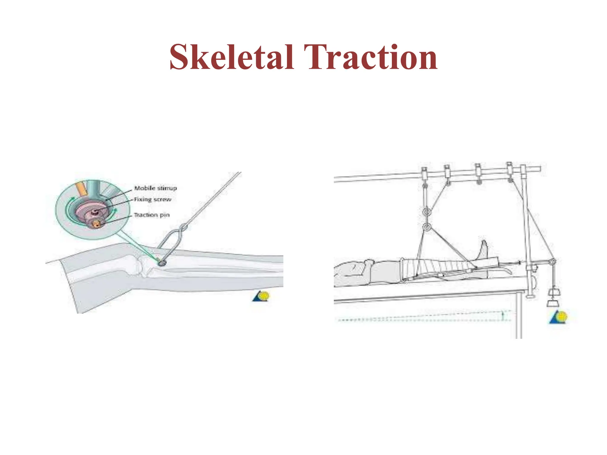 Skeletal Traction
 