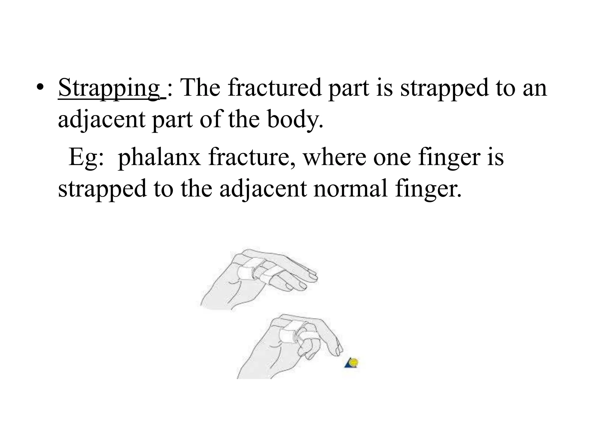 • Strapping : The fractured part is strapped to an
adjacent part of the body.
Eg: phalanx fracture, where one finger is
strapped to the adjacent normal finger.
 