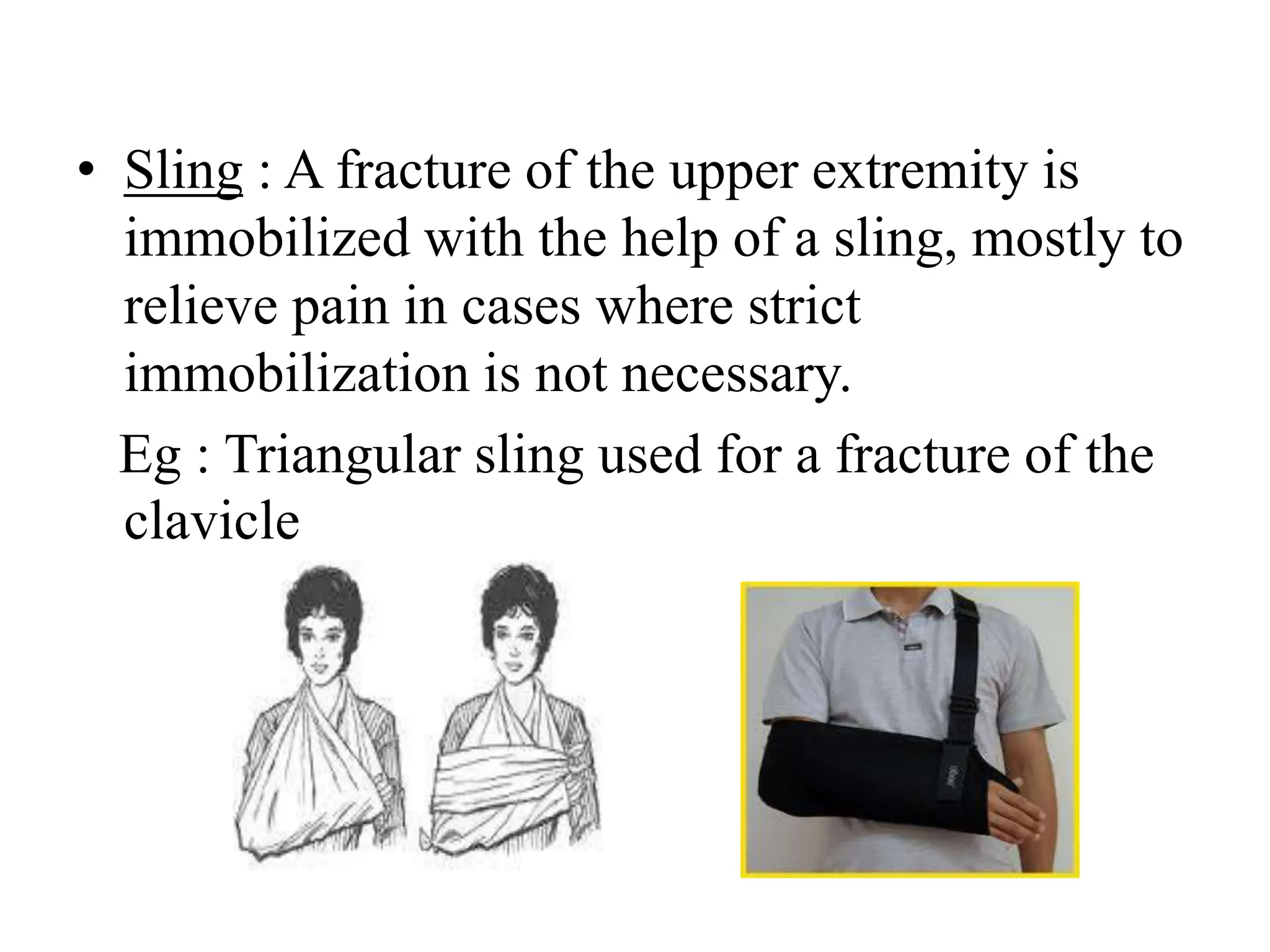 • Sling : A fracture of the upper extremity is
immobilized with the help of a sling, mostly to
relieve pain in cases where strict
immobilization is not necessary.
Eg : Triangular sling used for a fracture of the
clavicle
 