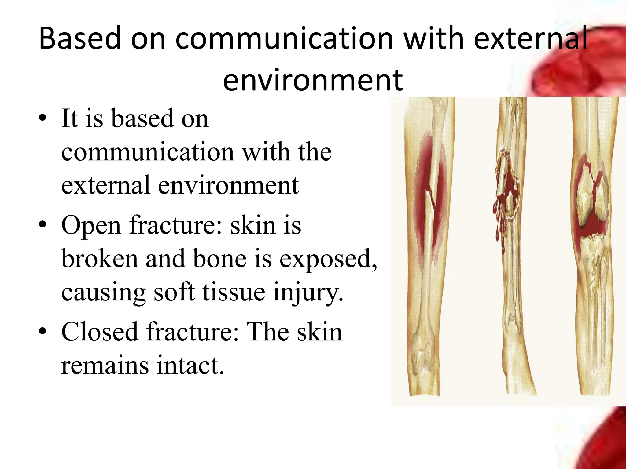 Based on communication with external
environment
• It is based on
communication with the
external environment
• Open fracture: skin is
broken and bone is exposed,
causing soft tissue injury.
• Closed fracture: The skin
remains intact.
 