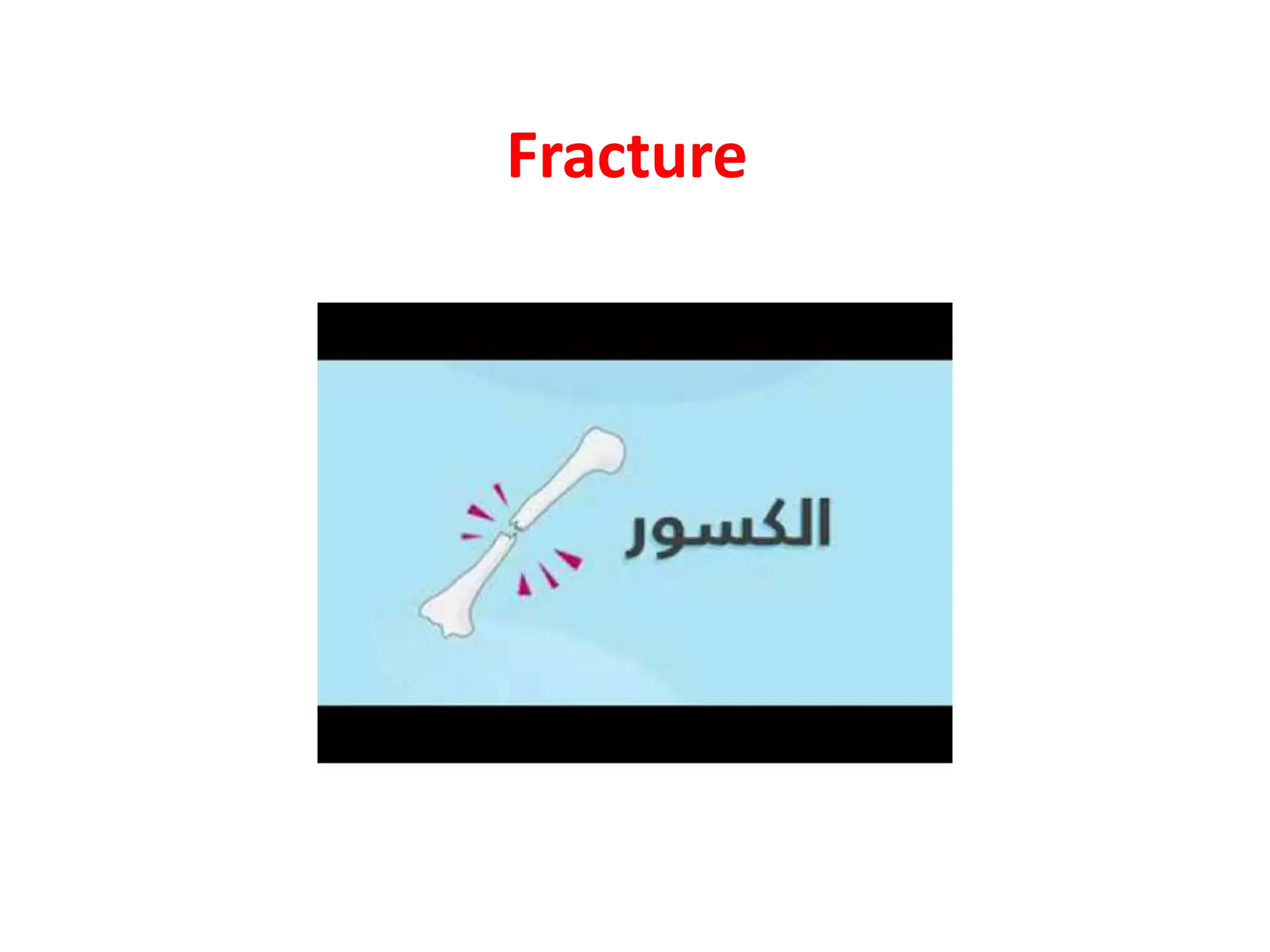 fracture-pptx