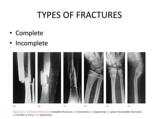 TYPES OF FRACTURES
• Complete
• Incomplete
 