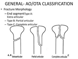 GENERAL- AO/OTA CLASSIFICATION
• Fracture Morphology
– End segmentType A:
Extra-articular
– Type B: Partial articular
– Type C: Complete articular
 