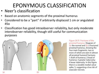 EPONYMOUS CLASSIFICATION
• Neer’s classification
• Based on anatomic segments of the proximal humerus
• Considered to be a ”part” if arbitrarily displaced 1 cm or angulated
45o
• Classification has good intraobserver reliability, but only moderate
interobserver reliability, though still useful for communication
purposes
 