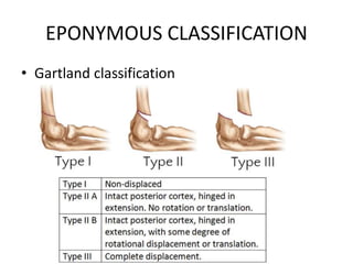 EPONYMOUS CLASSIFICATION
• Gartland classification
 