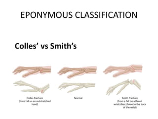 EPONYMOUS CLASSIFICATION
Colles’ vs Smith’s
 