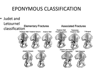 EPONYMOUS CLASSIFICATION
• Judet and
Letournel
classification
 