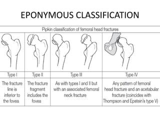 EPONYMOUS CLASSIFICATION
 
