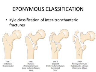 EPONYMOUS CLASSIFICATION
• Kyle classification of inter-tronchanteric
fractures
 