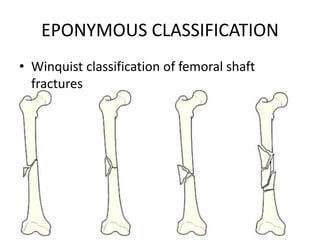 EPONYMOUS CLASSIFICATION
• Winquist classification of femoral shaft
fractures
 