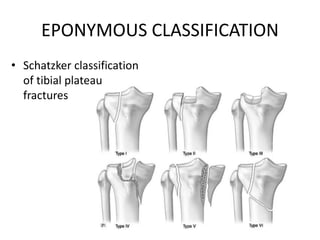 EPONYMOUS CLASSIFICATION
• Schatzker classification
of tibial plateau
fractures
 