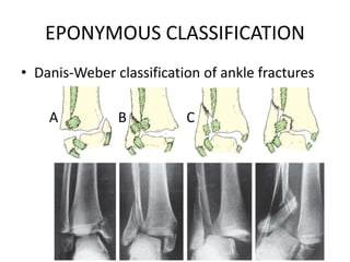 EPONYMOUS CLASSIFICATION
• Danis-Weber classification of ankle fractures
A B C
 