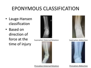 EPONYMOUS CLASSIFICATION
• Lauge-Hansen
classification
• Based on
direction of
force at the
time of injury
 