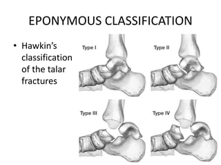 EPONYMOUS CLASSIFICATION
• Hawkin’s
classification
of the talar
fractures
 