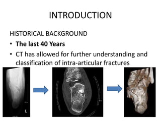 INTRODUCTION
HISTORICAL BACKGROUND
• The last 40 Years
• CT has allowed for further understanding and
classification of intra-articular fractures
 