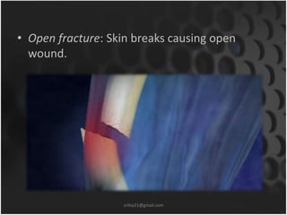 • Open fracture: Skin breaks causing open 
wound. 
sriloy21@gmail.com 
 