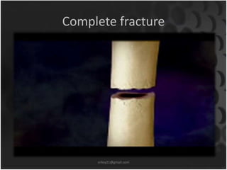 Complete fracture 
sriloy21@gmail.com 
 