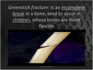 Greenstick fracture: is an incomplete 
break in a bone, tend to occur in 
children, whose bones are more 
flexible 
sriloy21@gmail.com 
 