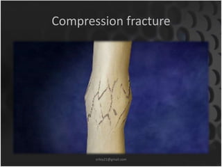 Compression fracture 
sriloy21@gmail.com 
 