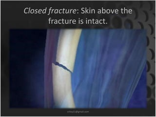 Closed fracture: Skin above the 
fracture is intact. 
sriloy21@gmail.com 
 