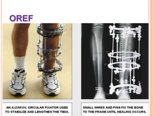 Oref Color Fracture,types and its management-MSN... | PDF