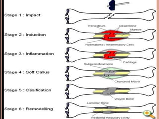 Fracture,types and its management-MSN... | PDF