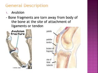 fracture-ppt.pptx
