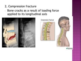 fracture-ppt.pptx
