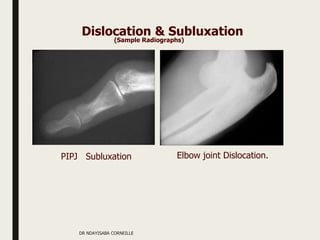 PIPJ Subluxation Elbow joint Dislocation.
Dislocation & Subluxation
(Sample Radiographs)
DR NDAYISABA CORNEILLE
 