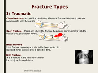 Closed fracture: A closed fracture is one where the fracture hematoma does not
communicate with the outside
Open fracture: This is one where the fracture hematoma communicates with the
outside through an open wound.
1/ Traumatic
Fracture Types
Stress fracture :
It is a fracture occurring at a site in the bone subject to
repeated minor stresses over a period of time.
Birth fracture:
It is a fracture in the new born children
due to injury during delivery.
DR NDAYISABA CORNEILLE
 