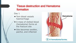 Tissue destruction and Hematoma
formation
Day 1
 Torn blood vessels
haemorrhage
 A mass of clotted blood
(hematoma) forms at
the fracture site
 Site becomes swollen,
painful, and inflamed
 