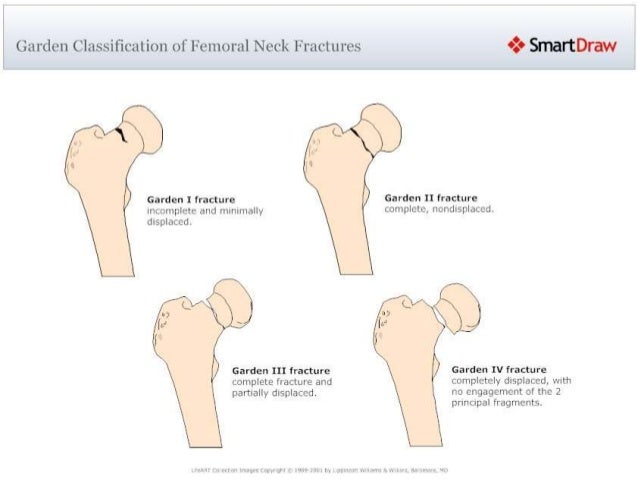 Fracture