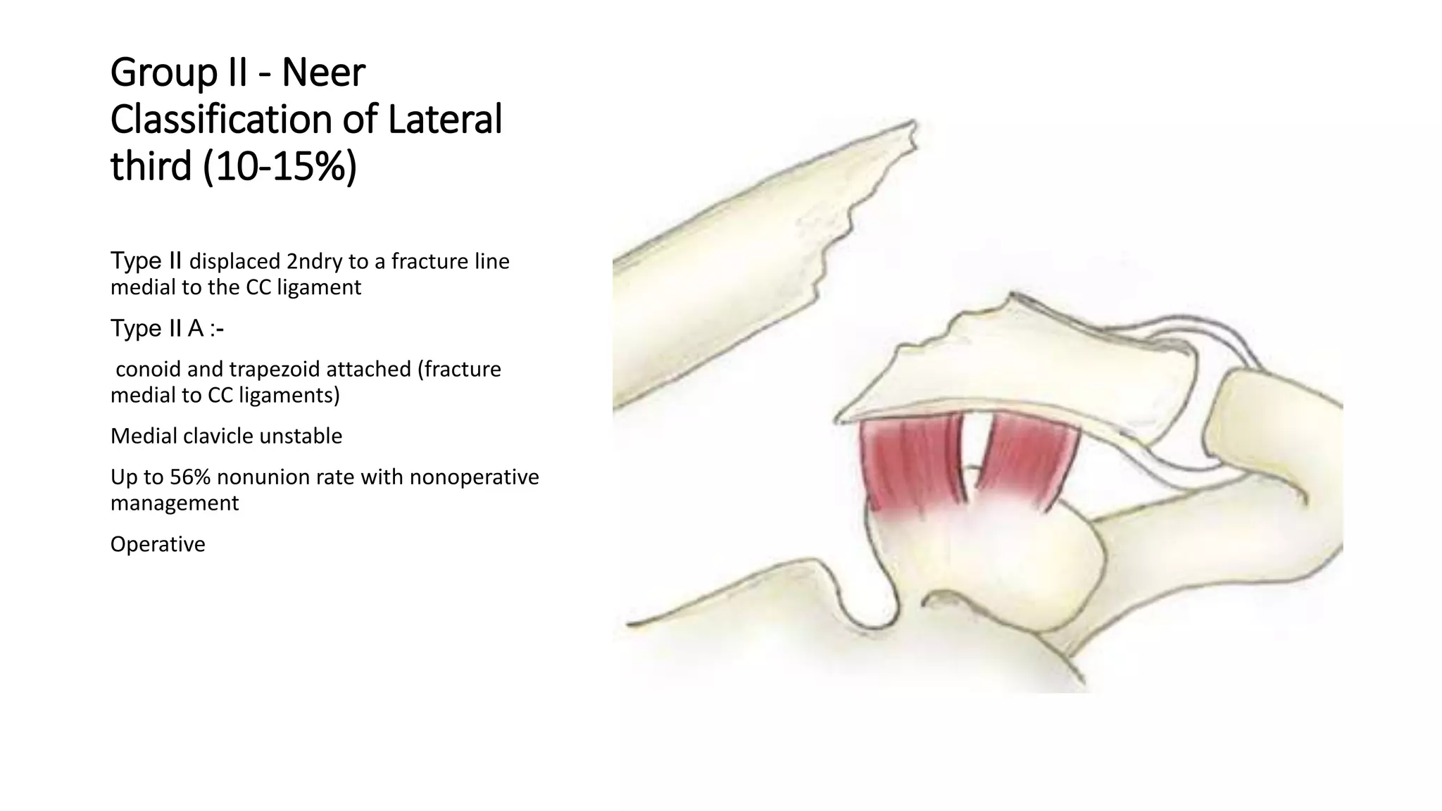 Group II - Neer
Classification of Lateral
third (10-15%)
Type II displaced 2ndry to a fracture line
medial to the CC ligament
Type II A :-
conoid and trapezoid attached (fracture
medial to CC ligaments)
Medial clavicle unstable
Up to 56% nonunion rate with nonoperative
management
Operative
 