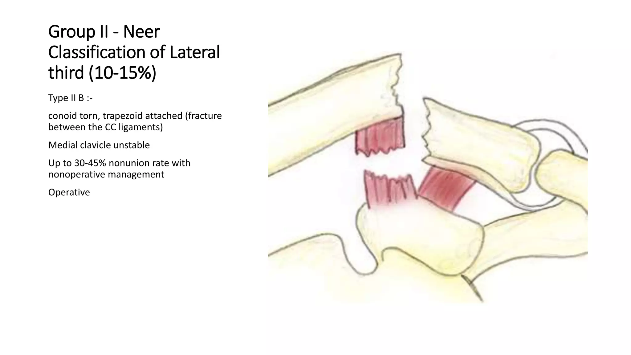 Group II - Neer
Classification of Lateral
third (10-15%)
Type II B :-
conoid torn, trapezoid attached (fracture
between the CC ligaments)
Medial clavicle unstable
Up to 30-45% nonunion rate with
nonoperative management
Operative
 