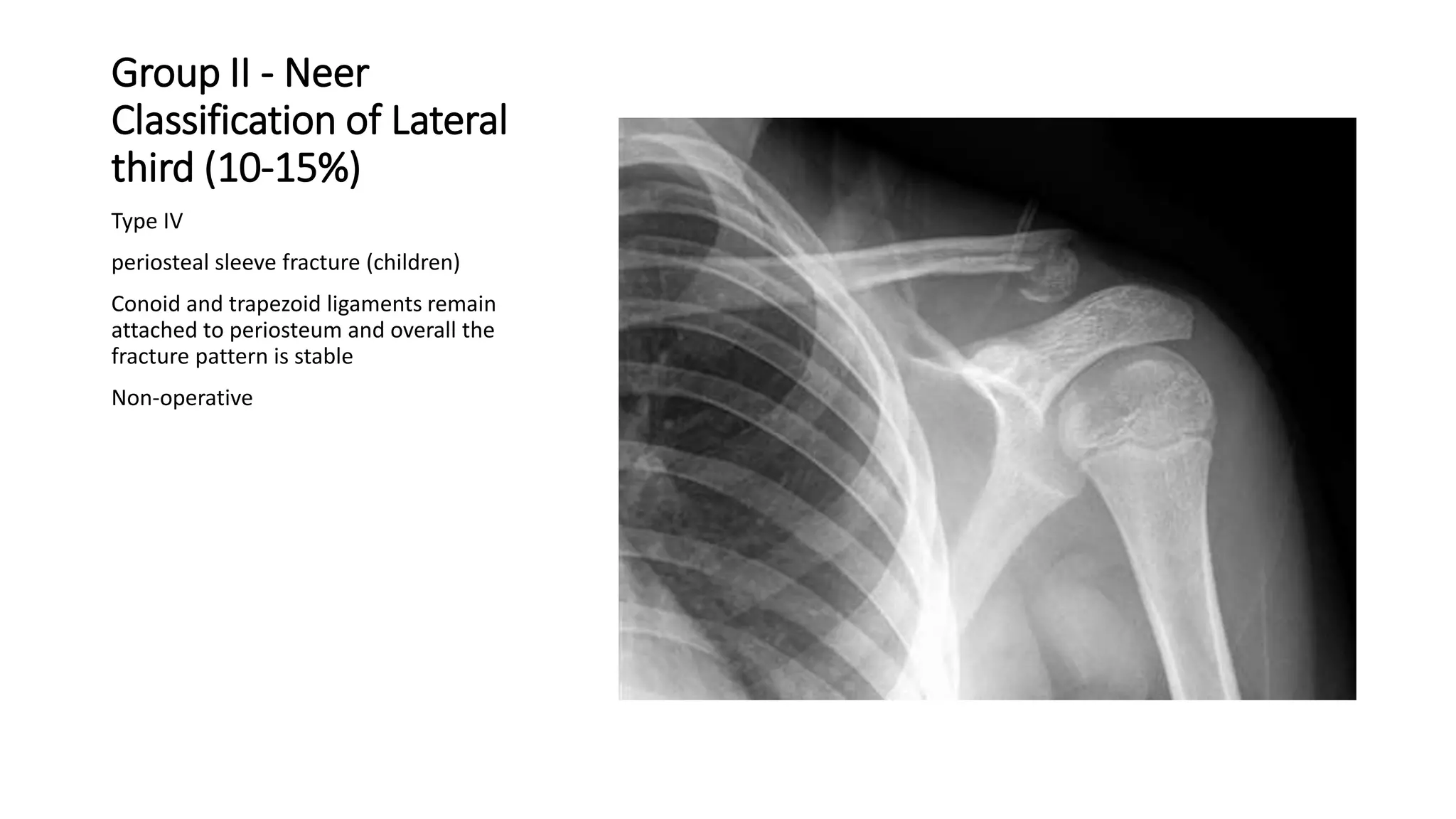 Group II - Neer
Classification of Lateral
third (10-15%)
Type IV
periosteal sleeve fracture (children)
Conoid and trapezoid ligaments remain
attached to periosteum and overall the
fracture pattern is stable
Non-operative
 