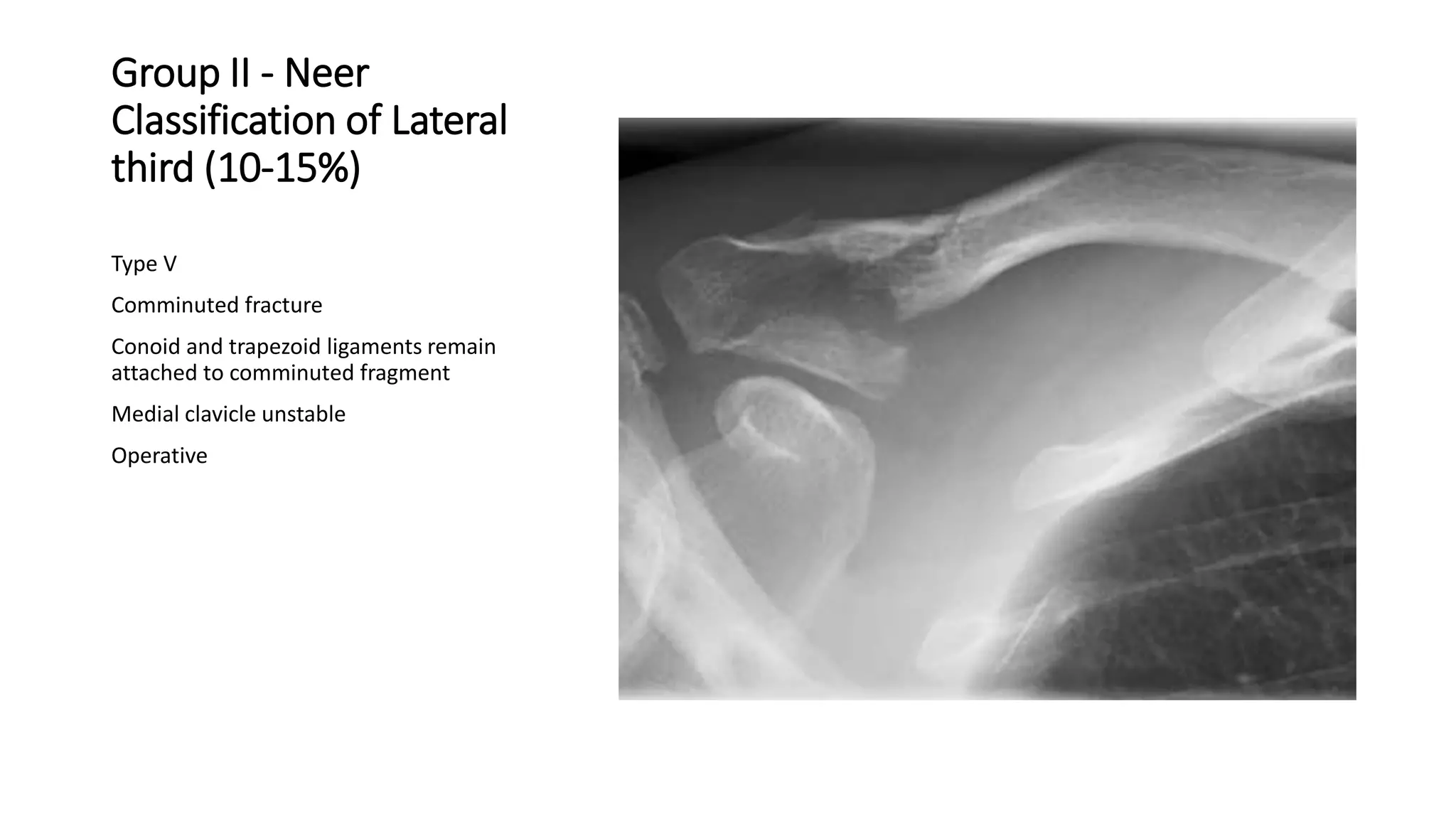 Group II - Neer
Classification of Lateral
third (10-15%)
Type V
Comminuted fracture
Conoid and trapezoid ligaments remain
attached to comminuted fragment
Medial clavicle unstable
Operative
 