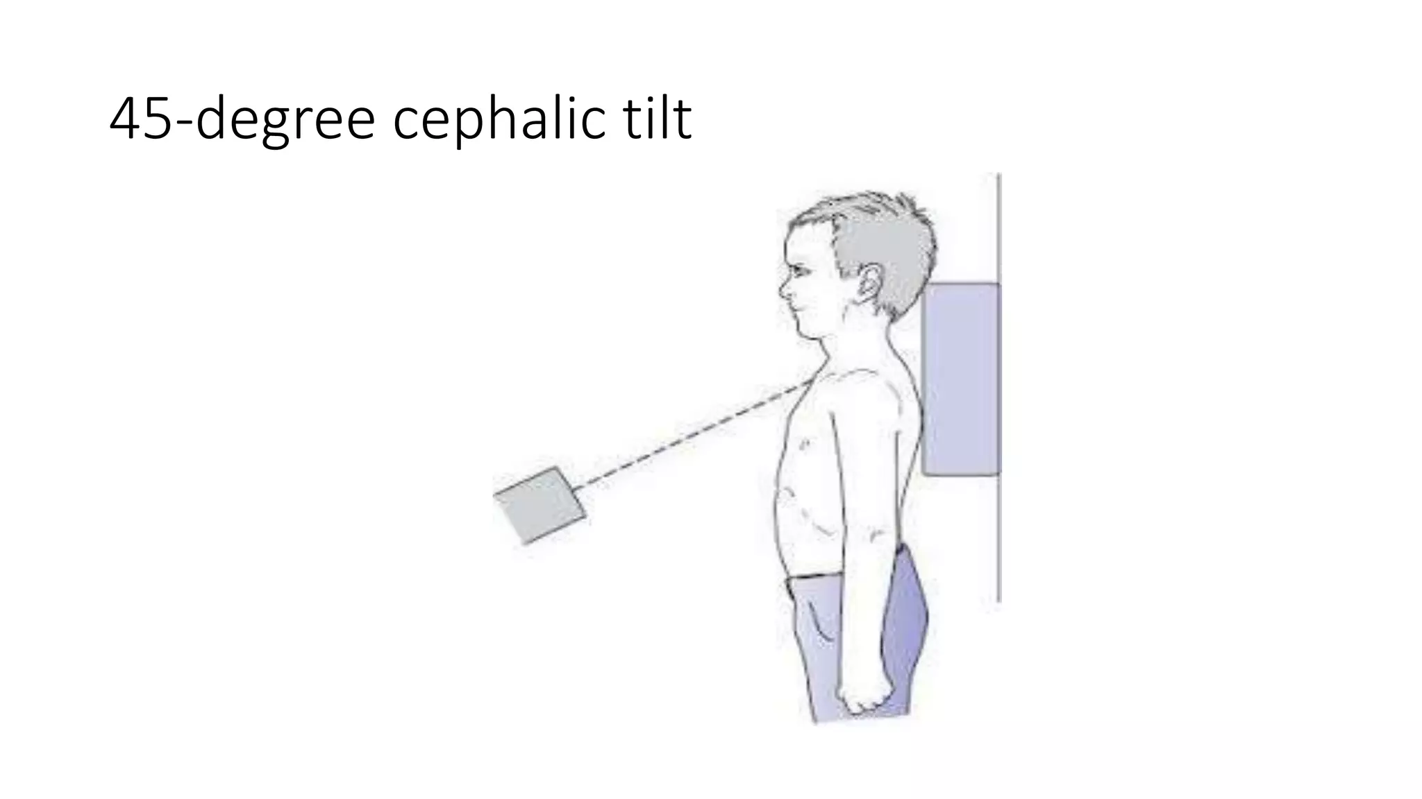 45-degree cephalic tilt
 