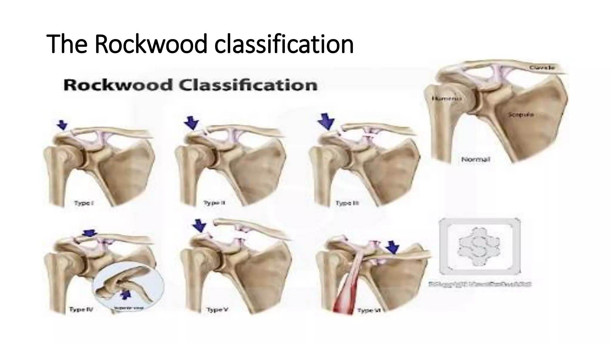 The Rockwood classification
 
